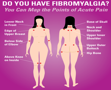 線維筋痛症（Fibromyalgia）